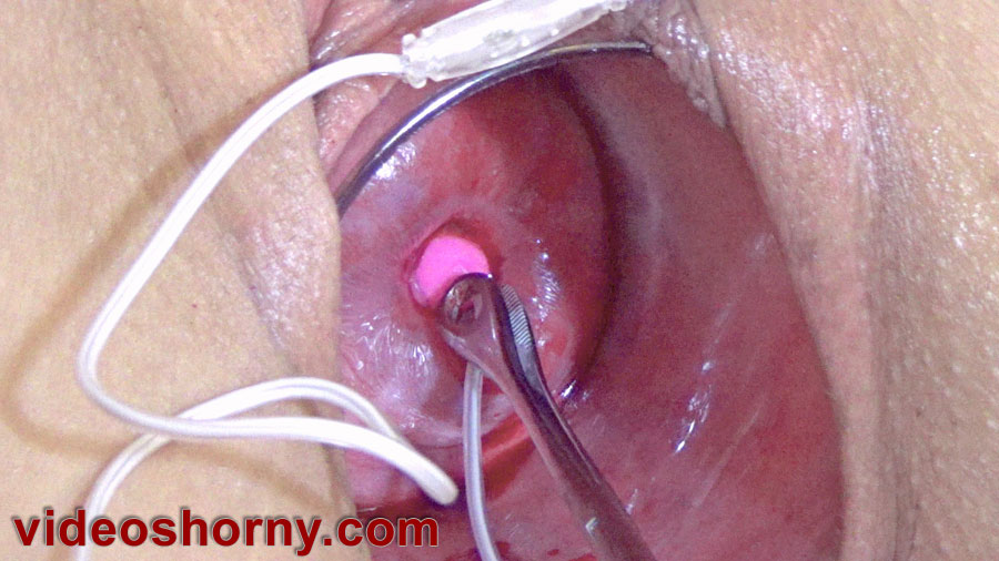 Insertion nasal catheter